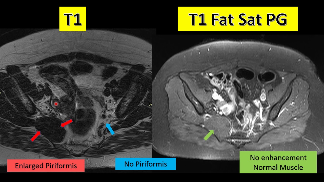 Two Minutes Case - Piriformis Syndrome - YouTube