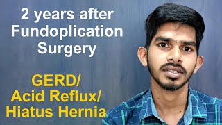 Acid Reflux Problem of Patient from Malda, West Bengal Is Fixed Permanently By Lap. Fundoplication