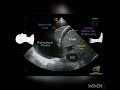 pleural effusion on ultrasound pocus pleuraleffusion