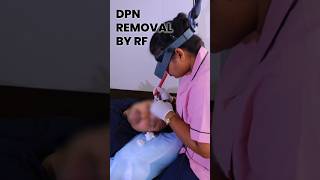 DPN Removal By RF | Clear Skin Pune