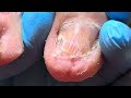 charity pedicure old man s onychomycosis grows wildly【xue yidao pedicure】