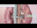 Anemia from Chronic Kidney Disease (CKD) - Treatment