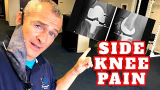 Pain on the Outside of My Knee Replacement