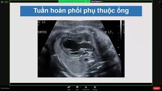 Các biểu hiện tim mạch cảnh báo ở thai nhi | PGS. TS. BS. Lê Minh Khôi