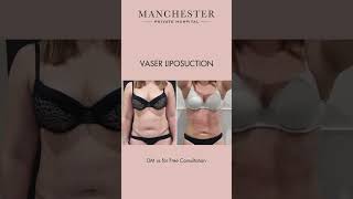 Vaser Liposuction Results: Stunning Before and After #vaserliposuction