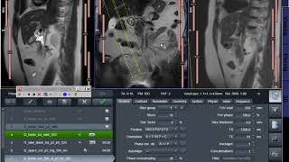 MRI planning Hol