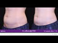 truSculpt iD Non-Invasive Fat Reduction | Advanced Specialty Care's Virtual Cosmetic Open House