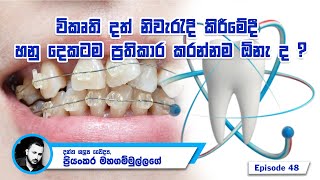 විකෘති දත් නිවැරැදි කිරීමේදී හනු දෙකටම ප්‍රතිකාර කරන්නම ඕනැ ද ? - Episode 48