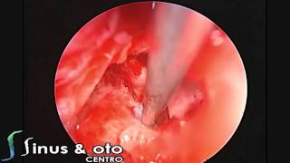 Temporal Bone Fracture with CSF Leak