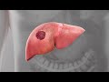 What Is Liver Cancer