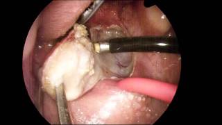 Coblation Tonsillectomy