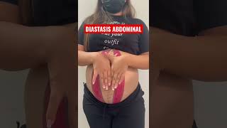 DIASTASIS ABDOMINAL🚨 #fisioterapia #embarazada #embarazo #diastaseabdominal #diastasis