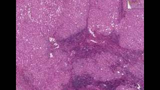 Histopathology Liver--Chronic active hepatitis, cirrhosis