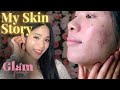 Hau Chic | Sharing My Skin Story with Glamtouch UK Vero Amore Skincare - How to cure acne prone skin