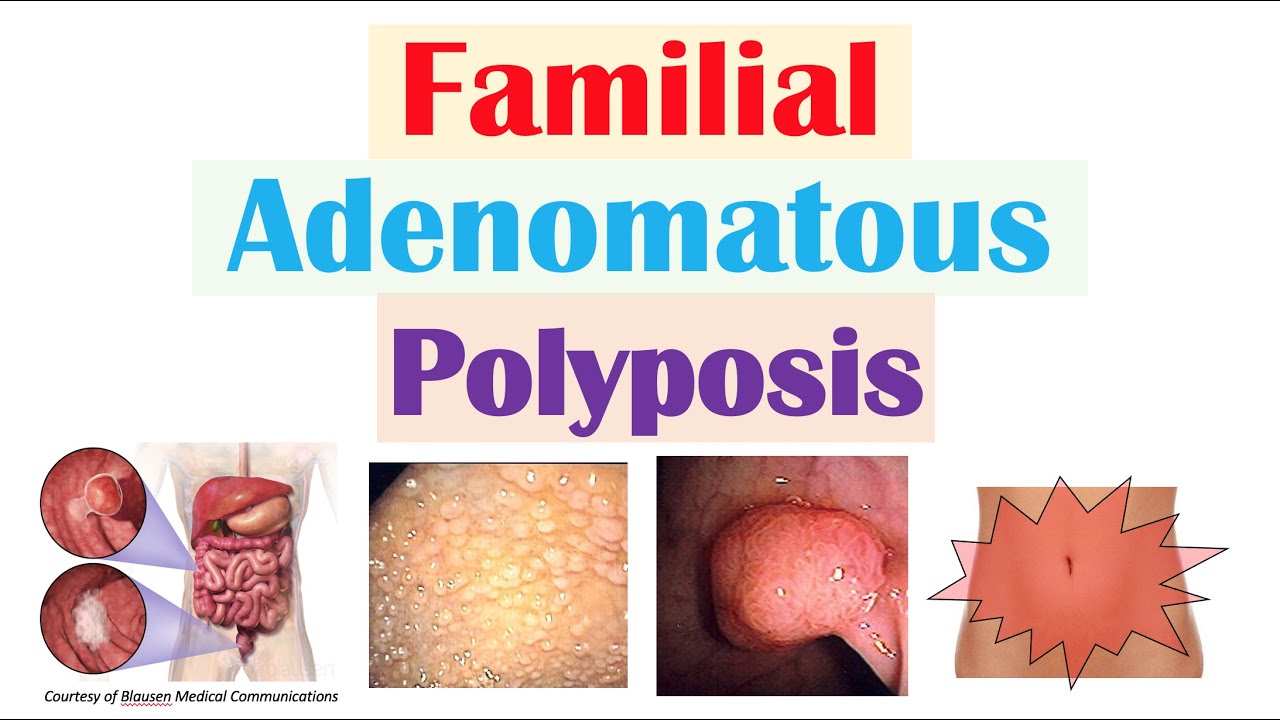 “Colon Cancer That Runs In Families” (Familial Adenomatous Polyposis ...