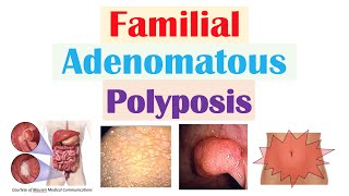 “Colon Cancer That Runs in Families” (Familial Adenomatous Polyposis), APC Gene, Symptoms, Treatment