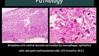 Diagnostic vitrectomy in uveitis [Dr. Emilio Maria Dodds]