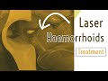 LASER Haemorrhoids Treatment I PILES operation I Laser SURGERY I Laser Haemorrhoidoplasty I Bawasir