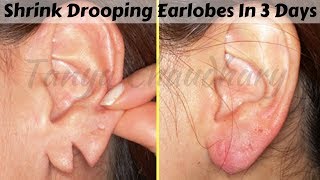 Shrink Drooping Earlobes In Just 3 Days Naturally At Home | 100% Effective Home Remedies