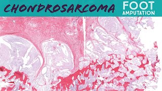 Chondrosarcoma of the foot (RARE SITE!) - amputation specimen (bone pathology)