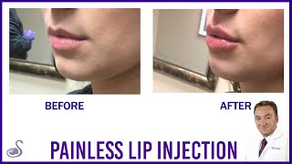 A Painless Lip Injection by Dr Simoni Beverly Hills