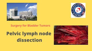 Pelvic lymph node dissection (PLND)