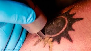 Download Mp3 How Laser Tattoo Removal Works - Smarter Every Day 123