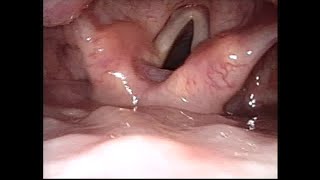 Isolated Myoclonus of the Vocal Folds in Alexander Disease