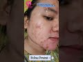 kulit bebas jerawat bukan hal yang mustahil lagi dengan radiant acne by drw skincare