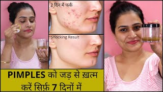 World's Best Toner| पिगमेंटेशन, blackhead छोटे-दाने, Pimples व दाग धब्बे हटाने का रामबाण इलाज| Acne