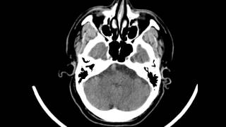 Mega-dolicho basilar artery (Head CT)