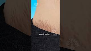 Why Do Stretch Marks Really Happen 😱 #shorts #viralvideo - Creativelearning3d