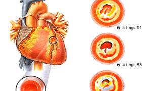 Biochemical Markers of Cardiac Injury