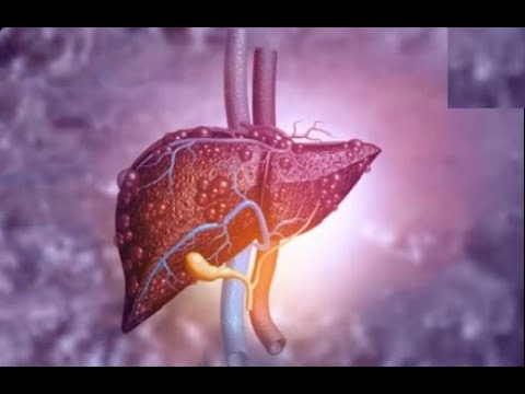 Fatty liver home remedies | Six foods that fight fatty liver Fatty liver home remedies | Six foods that fight fatty liver