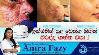 ඉක්මනින් සුදු වෙන්න ගිහින් වරද්දගන්න එපා | 360 wellness