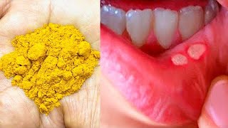 3 मिनट में मुँह और जीभ के छाले ठीक करने के लिए घरेलू उपाय How to get rid of Mouth Ulcer?