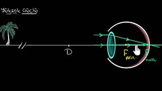 Miyopi ve Hipermetropi  (Fen Bilimleri) (Fizik)