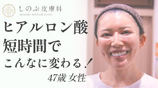 【マイナス10歳】ヒアルロン酸なら短時間で痛みなく変われる！47歳女性の本来の美しさを引き出して人生を変える｜ヒアルロン酸ビフォーアフター