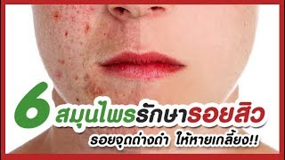 6 สุดยอดสมุนไพรลดรอยสิว จุดด่างดำให้หายเกลี้ยง!!  6 top herbs to reduce acne, dark spots.