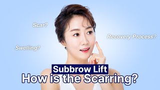 Everything on Subbrow Lift | Plastic Surgery Korea