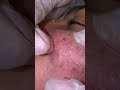 the best video removal black head