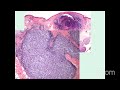 hemepath update on cutaneous b cell lymphomas