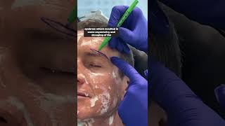 Direct Brow Life | Scar Excision | Dr. Jacob Sedgh #shorts