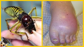 10 Najbardziej bolesnych ukąszeń owadów