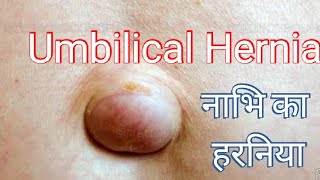 Open Umbilical Hernia operation हिंदी में सब कुछ