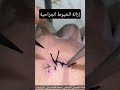 كيفية ازالة الخيوط الجراحية الغرز الجراحية how to remove surgical sutures shorts محمد_قاسم