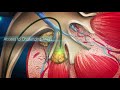 laser fibre slimline by lumenis 3d medical device animation