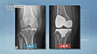 환자의 몸 상태를 고려한 무릎 인공관절 수술 | 달콤한 인생 2회 | JTBC 230113 방송