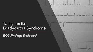 Tachycardia-Bradycardia Syndrome: ECG Findings Explained