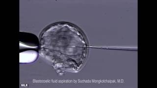 Suchada Mongkolchaipak, Trophectoderm biopsy VS Blastocoelic aspiration by หมอสุชาดา